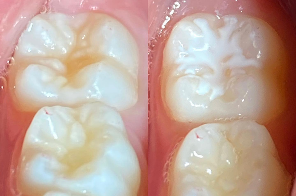 Dhëmbët e Pjekurisë