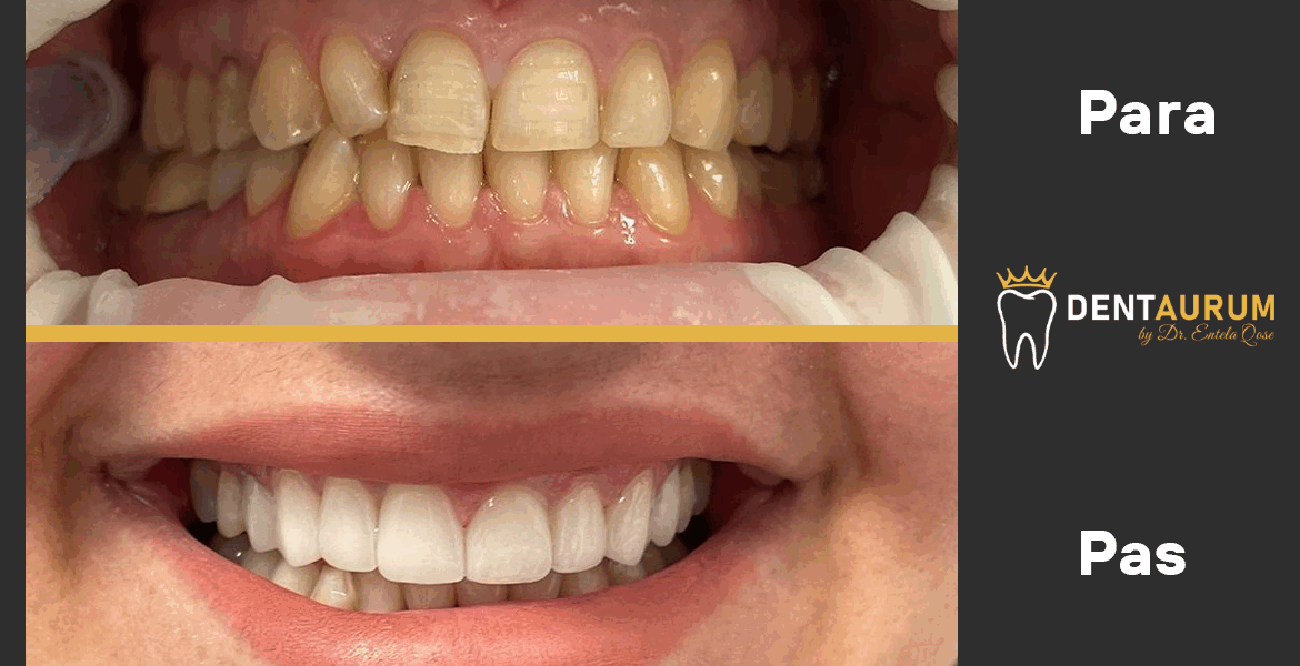 Estetikë Dentare me faseta Emax