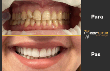 Estetikë Dentare me faseta Emax