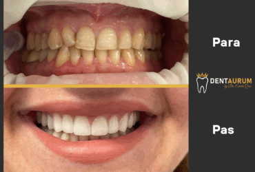 Estetikë Dentare me faseta Emax