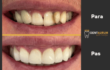 GingiviPlastikë + Kurora E-Max