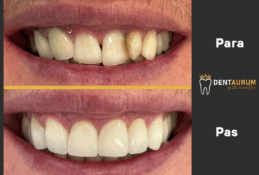 GingiviPlastikë + Kurora E-Max