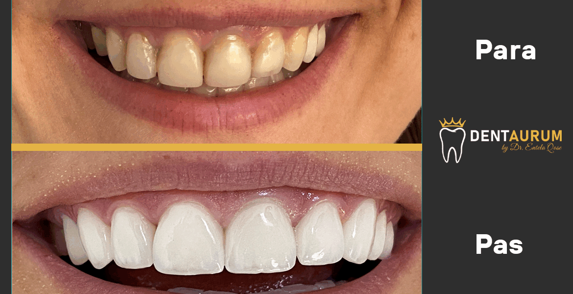 Faseta E-Max + Estetikë dentare