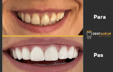 Faseta E-Max + Estetikë dentare