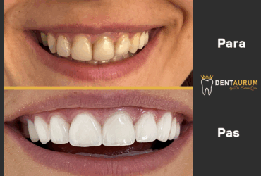 Faseta E-Max + Estetikë dentare