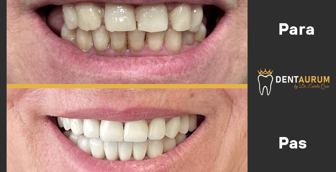 Estetikë Dentare + Metal Porcelan