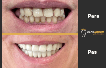Estetikë Dentare + Metal Porcelan