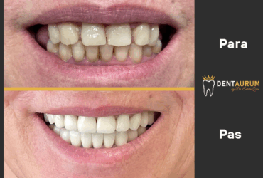 Estetikë Dentare + Metal Porcelan
