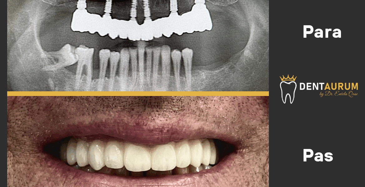 Implante Dentare All-on-6