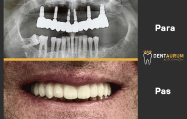 Implante Dentare All-on-6